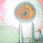 Δευτερογενής ανθέη φακού ιριδικής στήριξης