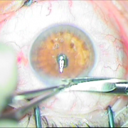 Περιφερική Ιριδεκτομή