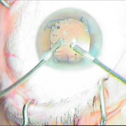 ΠΡ.ΥΑΛΟΕΙΔΕΚΤΟΜΗ