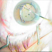 Ένθεση φακού οπ. θαλάμου