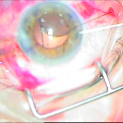 Συραφή του ίδιου φακού πίσω από την ίριδα