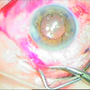 Ευθυγραμμισμένος ενδοφακός