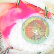 Τοποθέτηση ειδικού δαχτυλίου