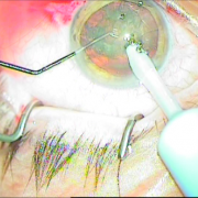 Φακοθρυψία