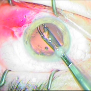 Τοποθέτηση αναδιπλούμενου φακού