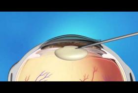 Επέμβαση Καταρράκτη