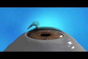 LASIK Κερατοτόμος