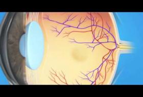 Κλαδική Απόφραξη Φλέβας Αμφιβληστροειδούς