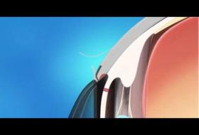 Εγχείριση Γλαυκώματος